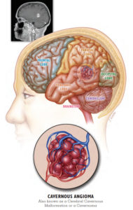 cavernoma lesion in the temporal lobe
