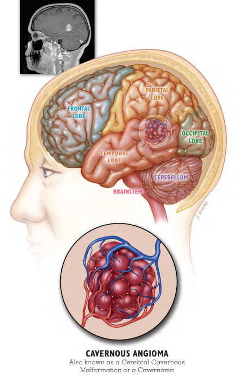 Cavernous Angioma