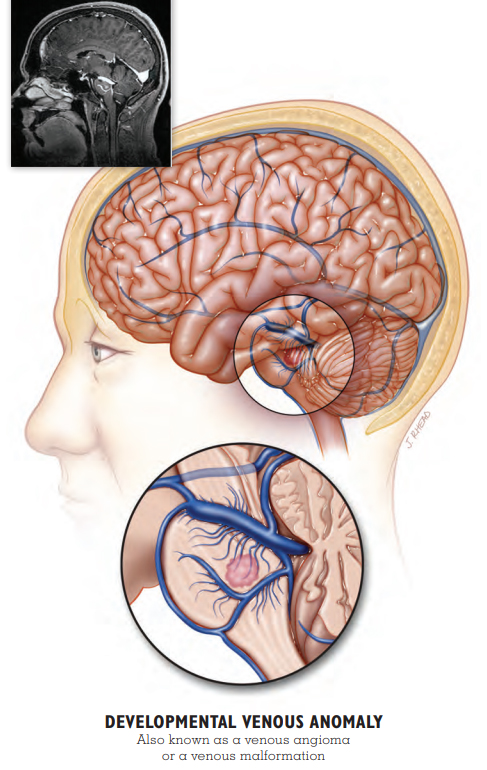 Developmental Venous Anomaly