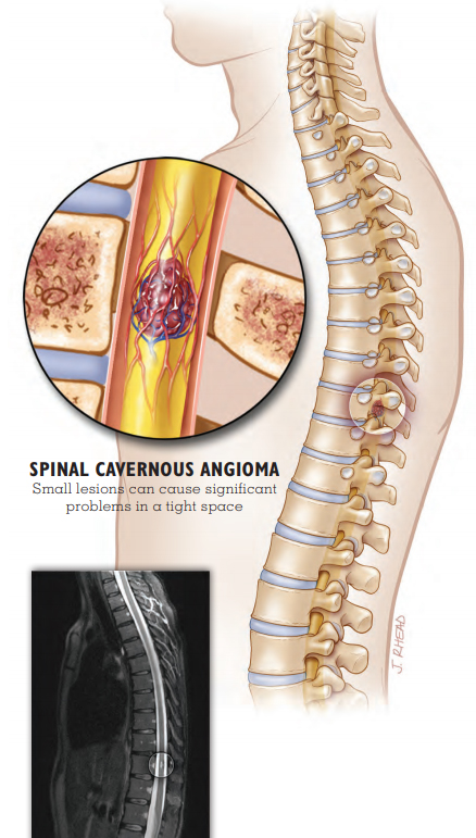 Spinal Cavernous Angioma