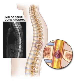 Spinal Cord Cavernous Angioma illustration.