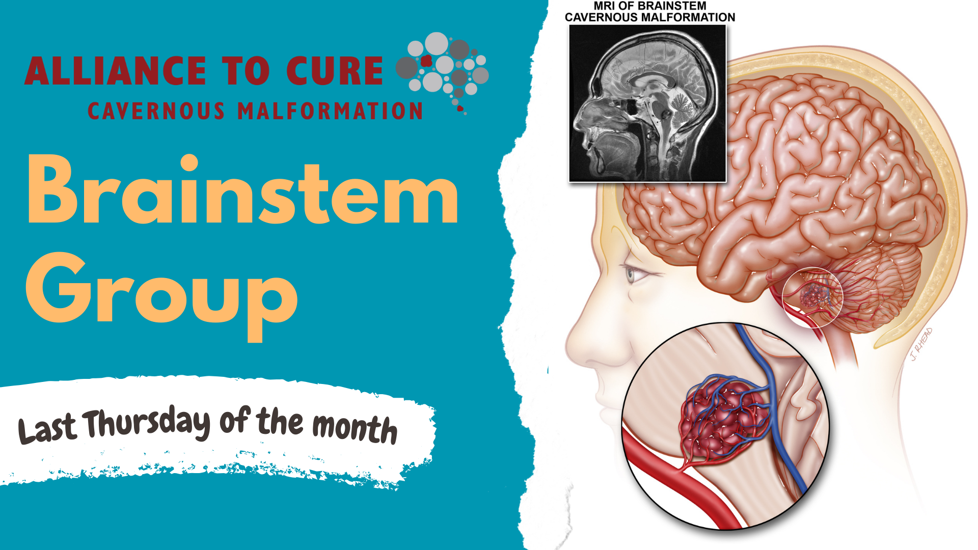 Anatomical illustration of the human brain highlighting the brainstem, with an inset showing a cavernous malformation. Includes an MRI scan displaying a brainstem abnormality. Text reads: “Alliance to Cure Cavernous Malformation – Brainstem Group – Last Thursday of the month.” Designed to promote a support group for individuals affected by brainstem cavernous malformations.